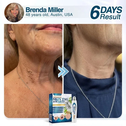 🇺🇸 CureVivo® Advanced Skin Tag & Wart Removal Roller 🧑🏼‍⚕️