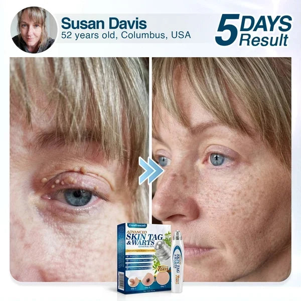 🇺🇸 CureVivo® Advanced Skin Tag & Wart Removal Roller 🧑🏼‍⚕️
