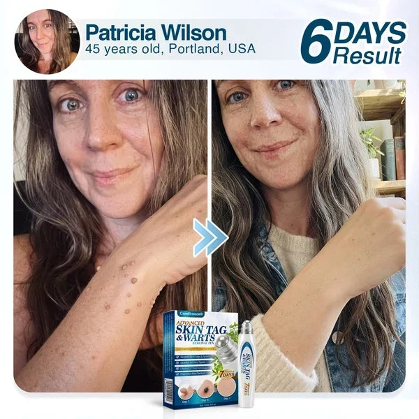 🇺🇸 CureVivo® Advanced Skin Tag & Wart Removal Roller 🧑🏼‍⚕️