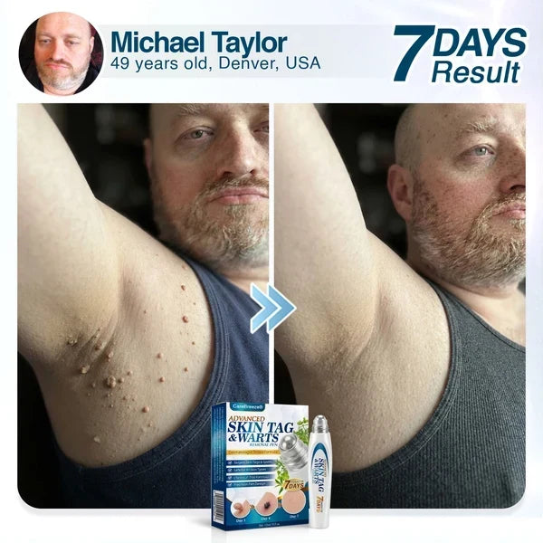 🇺🇸 CureVivo® Advanced Skin Tag & Wart Removal Roller 🧑🏼‍⚕️