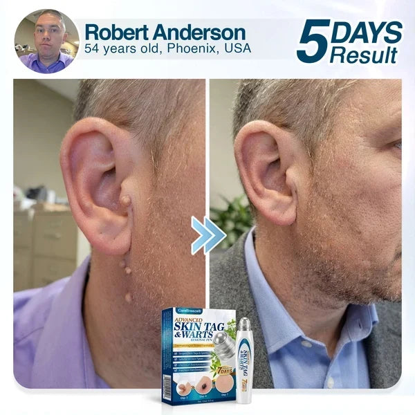 🇺🇸 CureVivo® Advanced Skin Tag & Wart Removal Roller 🧑🏼‍⚕️